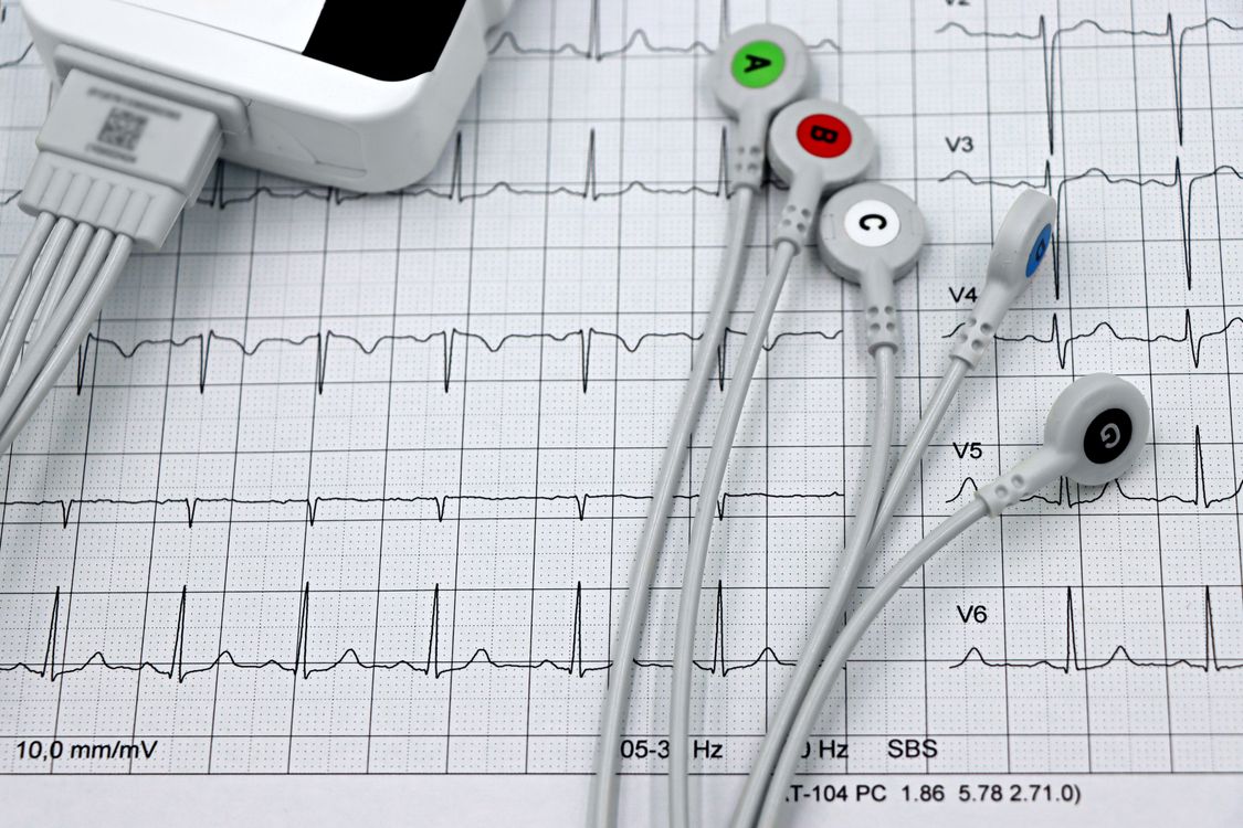 Electrocardiograma mostrando el ritmo cardíaco en papel cuadriculado médico.